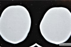 disostosis-cleido-craneal-rn3m1a2a-tac-rn5m1996-026