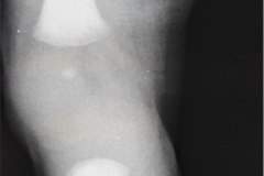 disostosis-cleido-craneal-rn3m1a2a-tac-rn5m1996-028