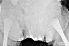 disostosis-cleido-craneal-rn3m1a2a-tac-rn5m1996-030