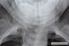 disostosis-cleido-craneal-rn3m1a2a-tac-rn5m1996-032