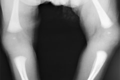 disostosis-cleido-craneal-rn3m1a2a-tac-rn5m1996-033