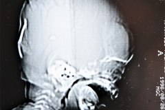 disostosis-cleido-craneal-rn3m1a2a-tac-rn5m1996-034