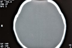 disostosis-cleido-craneal-tac-reconstruccion-tridimencional-5a2000-001