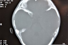 disostosis-cleido-craneal-tac-reconstruccion-tridimencional-5a2000-012
