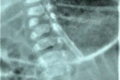 disostosis-espondilocostal-espondilotoracica-jarcho-levin-000
