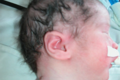 displasia-acromesomelica-enanismo-2009-009