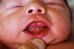 displasia-acromesomelica-enanismo-000