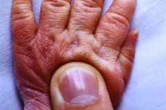 displasia-acromesomelica-enanismo-007