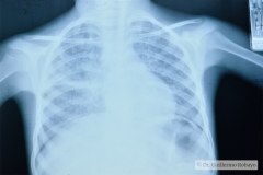 displasia-broncopulmonar-dbp-1988-004