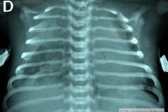 displasia-broncopulmonar-dbp-2004-001