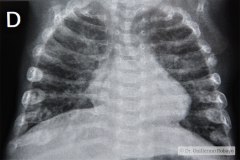 displasia-broncopulmonar-dbp-osteopenia-eom-raquitismo-2004-001