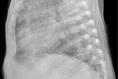 displasia-broncopulmonar-osteopenia-raquitismo-2007-05-30-h-leidy-hilarion-000