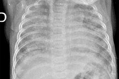displasia-broncopulmonar-osteopenia-raquitismo-2007-05-30-h-leidy-hilarion-001