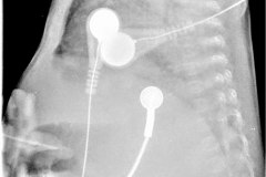 displasia-broncopulmonar-osteopenia-sonda-gastostomia-2007-000