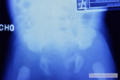 displasia-mesomelica-tipo-reinhardt-pfeiffer-009
