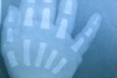 displasia-mesomelica-tipo-reinhardt-pfeiffer-019