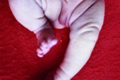 displasia-rizomelica-enanismo-006