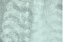 displasia-tanatoforica-enanismo-2003-010