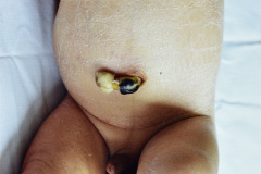 distension-abdominal-meconio-espeso-001