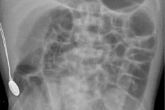 distension-abdominal-sin-edema-de-asas-silueta-cardiotimica-normal-2007-002