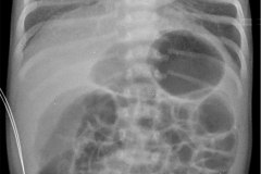 distension-abdominal-sin-edema-de-asas-silueta-cardiotimica-normal-2007-004