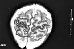 distrofia-muscular-miopatia-cronica-rnm-1999-007