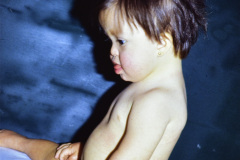 down-2a-cicatriz-correccion-cardiopatia-002