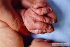 down-braquidactilia-linea-unica-palmar-izq-000