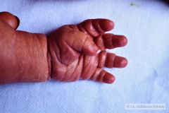 down-braquidactilia-linea-unica-palmar-izq-001