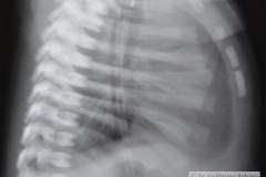 down-canal-auriculo-ventricular-1990-000
