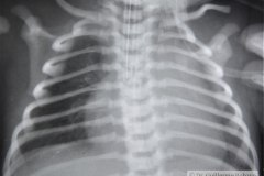 down-canal-auriculo-ventricular-1990-001