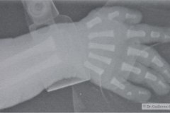 down-clinodactilia-bil-quinto-dedo-mano-hipoplasia-falange-media-1989-000