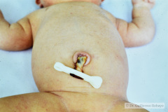 down-deslizamiento-lengua-hipotonia-implantacion-baja-oreja-criptorquidia-der-000