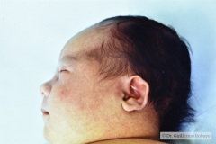 down-deslizamiento-lengua-hipotonia-implantacion-baja-oreja-criptorquidia-der-005