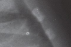 down-doble-nucleo-osificacion-mango-esternon-1991-001