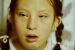 down-endotropia-izq-linea-palmar-unica-cardiopatia-000