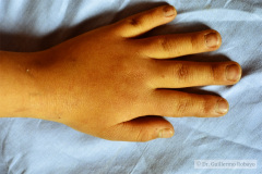 down-endotropia-izq-linea-palmar-unica-cardiopatia-001