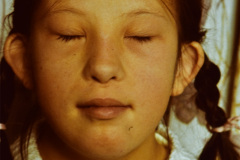 down-endotropia-izq-linea-palmar-unica-cardiopatia-003