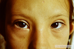 down-endotropia-izq-linea-palmar-unica-cardiopatia-008