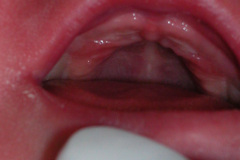 down-hipertelorismo-palpebral-mamario-polidactilia-preaxial-cuello-alado-dap-2005-001
