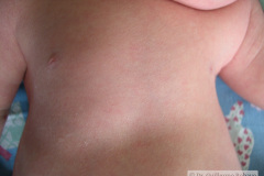 down-hipertelorismo-palpebral-mamario-polidactilia-preaxial-cuello-alado-dap-2005-012