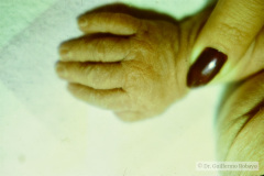 down-implantacion-baja-pabellon-izq-001