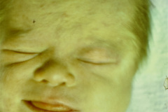 down-leucemia-congenita-caso-clinico-rn-2m-002