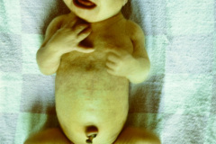 down-leucemia-congenita-caso-clinico-rn-2m-003