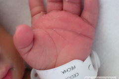 down-micrognatia-extrusion-lingual-linea-unica-palmar-2003-000