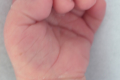 down-micrognatia-extrusion-lingual-linea-unica-palmar-2003-003