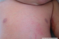 down-micrognatia-extrusion-lingual-linea-unica-palmar-2003-004