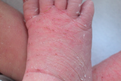 down-micrognatia-extrusion-lingual-linea-unica-palmar-2003-005
