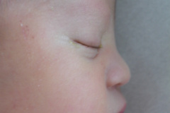 down-micrognatia-extrusion-lingual-linea-unica-palmar-2003-008