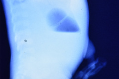 down-pancreas-anular-obstruccion-duodenal-signo-doble-burbuja-postop-sonda-duodenostomia-fototerapia-criolla-000